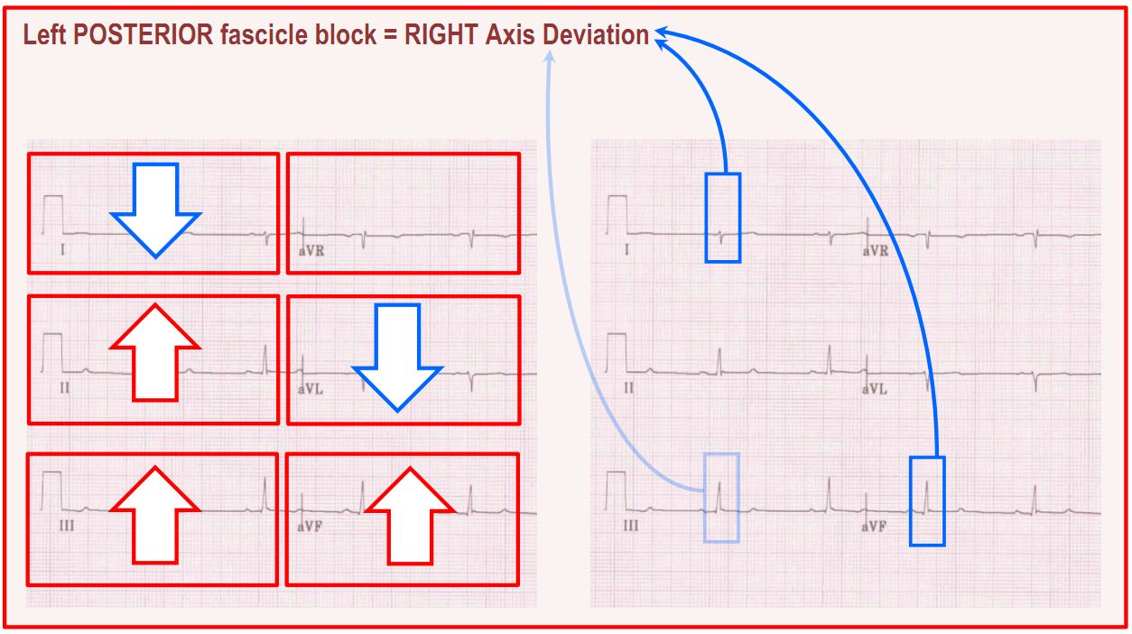 Left posterior fascicular block Deranged Physiology